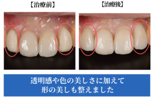 ラミネートベニアの症例画像