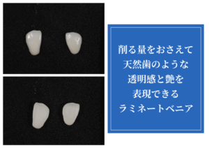 ラミネートベニア画像