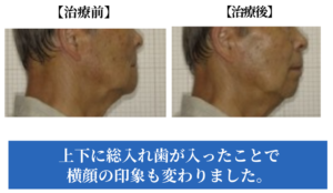 入れ歯症例の治療前後症例画像