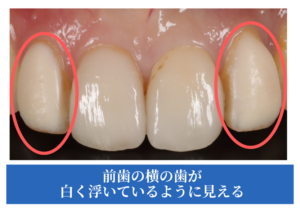 治療前の悩み前歯の色の違い