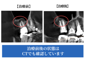治療前後のCT画像