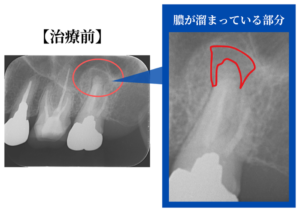 治療前のレントゲン写真