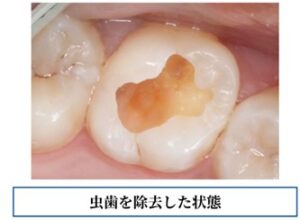 虫歯除去した症例画像