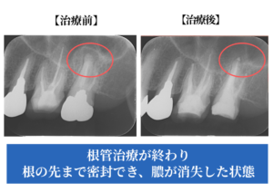 治療前後比較レントゲン