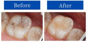BeforeAfterの症例画像