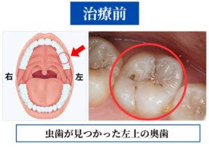 治療前の歯の状態