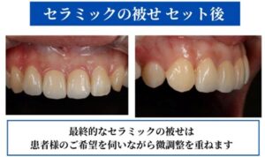 セラミックの被せセット後