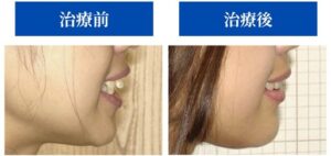 治療前後の横顔症例画像