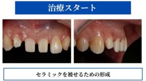 セラミックをかぶせるための形成