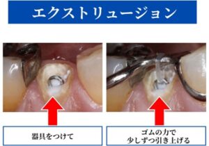 エクストリュ―ジョン法の経過画像