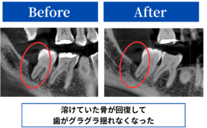 治療前後の症例レントゲン