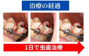 虫歯治療の経過画像