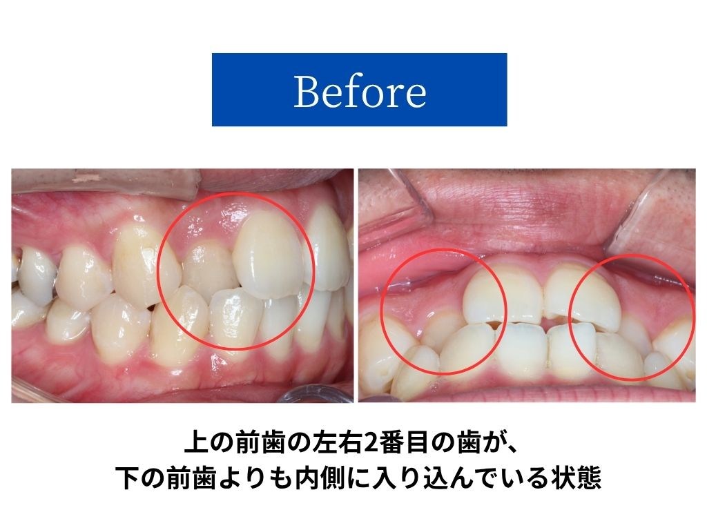 治療前｜上の前歯の左右2番目が内側に入り込んでいる状態
