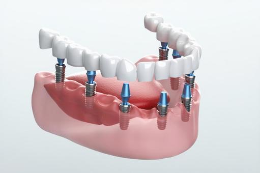 仕事で忙しい方へ｜インプラント治療を早く終わらせることができます｜岡山にある歯医者【政久歯科醫院】