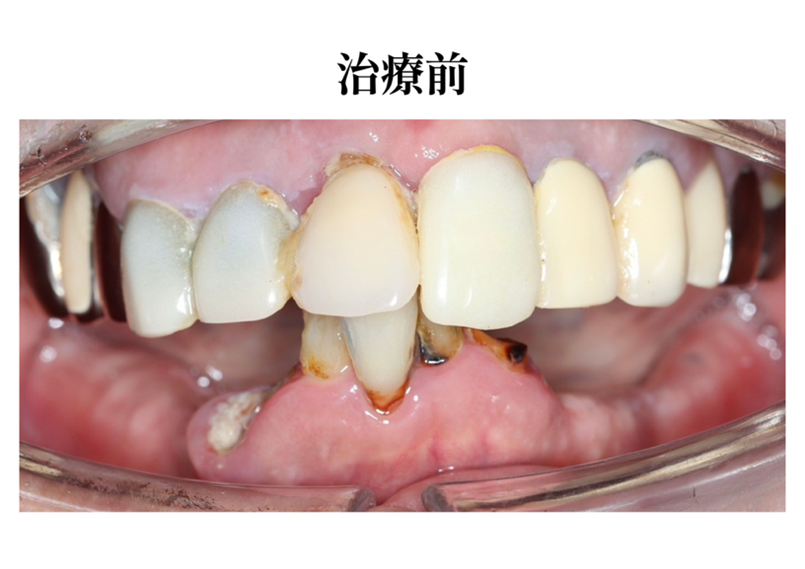 【症例紹介】入れ歯が合わない方へ—オールオン4で叶えた快適な噛み心地｜岡山市にある歯医者【政久歯科醫院】