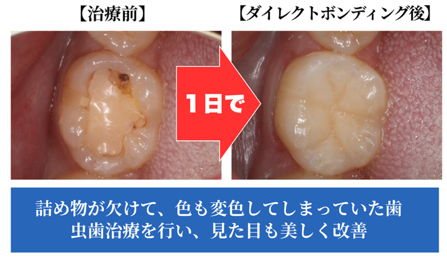 【症例紹介】まるで自分の歯みたい！削る量も少なく1日で白く綺麗い歯へ｜ダイレクトボンディング治療｜岡山市にある歯医者【政久歯科醫院】