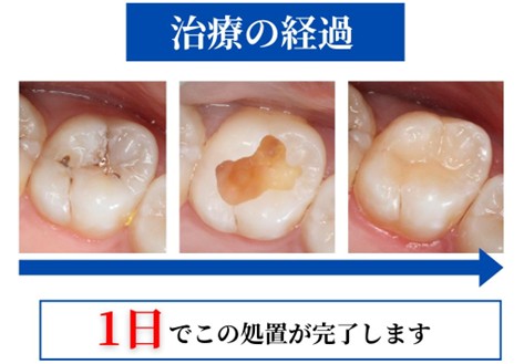【症例紹介】進行した奥歯の虫歯を1日で自然な見た目に回復｜左上6番ダイレクトボンディング治療｜岡山市にある歯医者【政久歯科醫院】