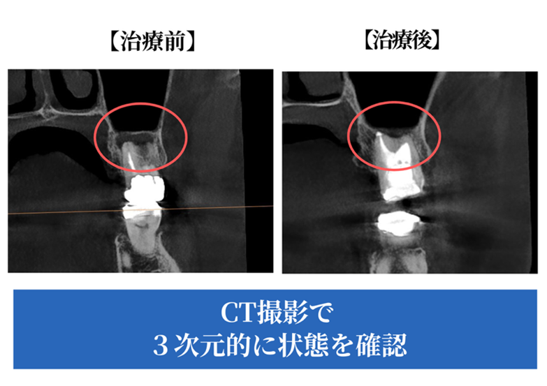 【症例紹介】「抜かずに残したい」―精密根管治療で痛みが消失した症例｜岡山市にある歯医者【政久歯科醫院】