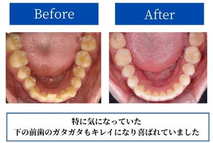 【症例紹介】2年間のマウスピース矯正治療で、下の歯のガタガタした見た目と舌の痛みから解放。｜岡山市にある歯医者【政久歯科醫院】