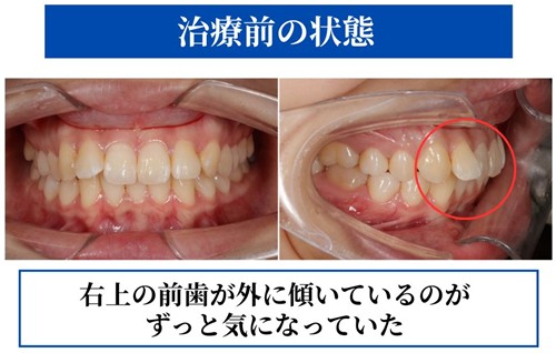 【症例紹介】矯正はしたくない。でも前歯の歯並びをきれいにしたい｜20代女性がセラミック治療を選んだ症例｜岡山市にある歯医者【政久歯科醫院】